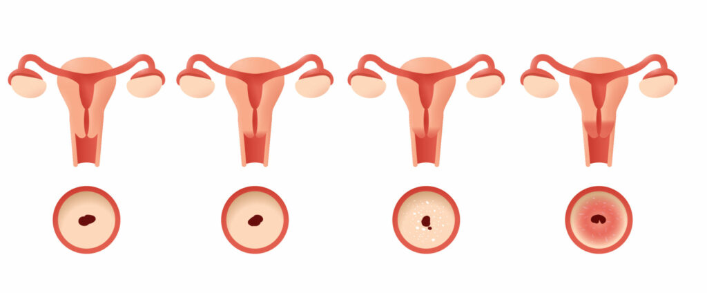 Evolução do câncer de colo de útero. (1) Útero normal, (2 e 3) lesões precursoras (4) câncer.