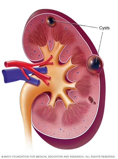 doença renal crônica - cisto renal